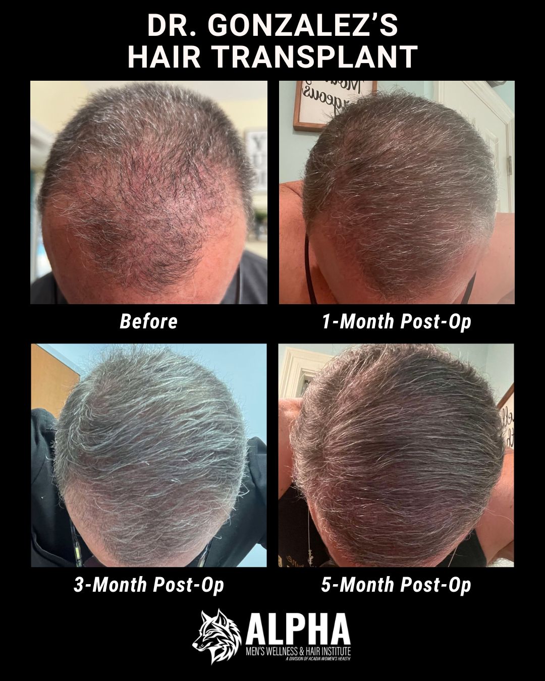 Hair Restoration | Alpha Men's Wellness